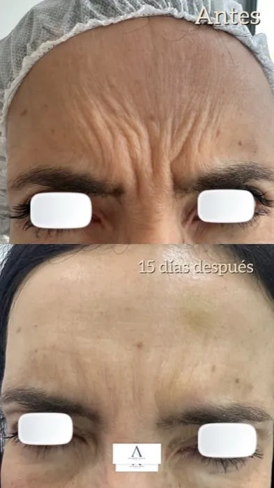 Toxina Botulínica