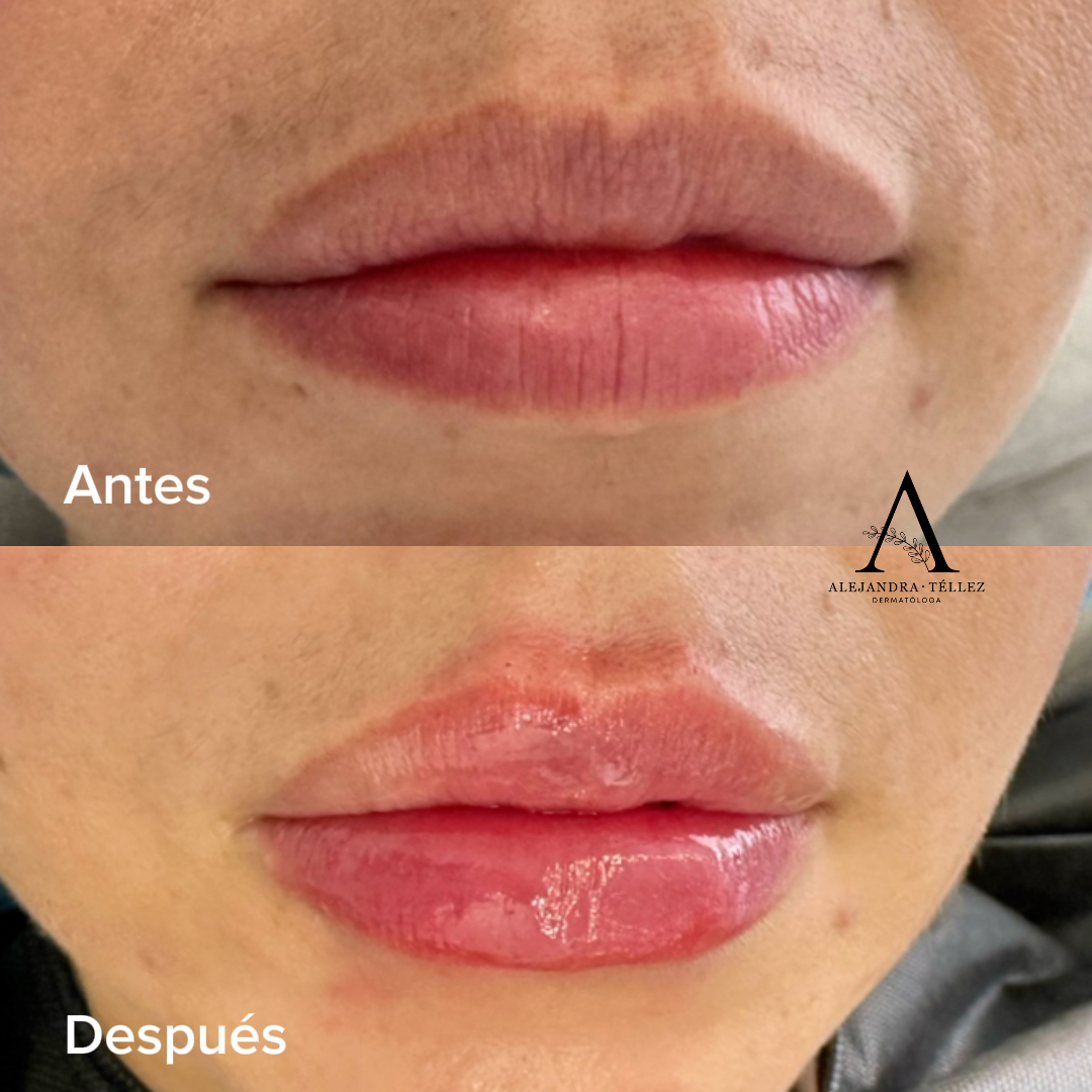 AH · Labios