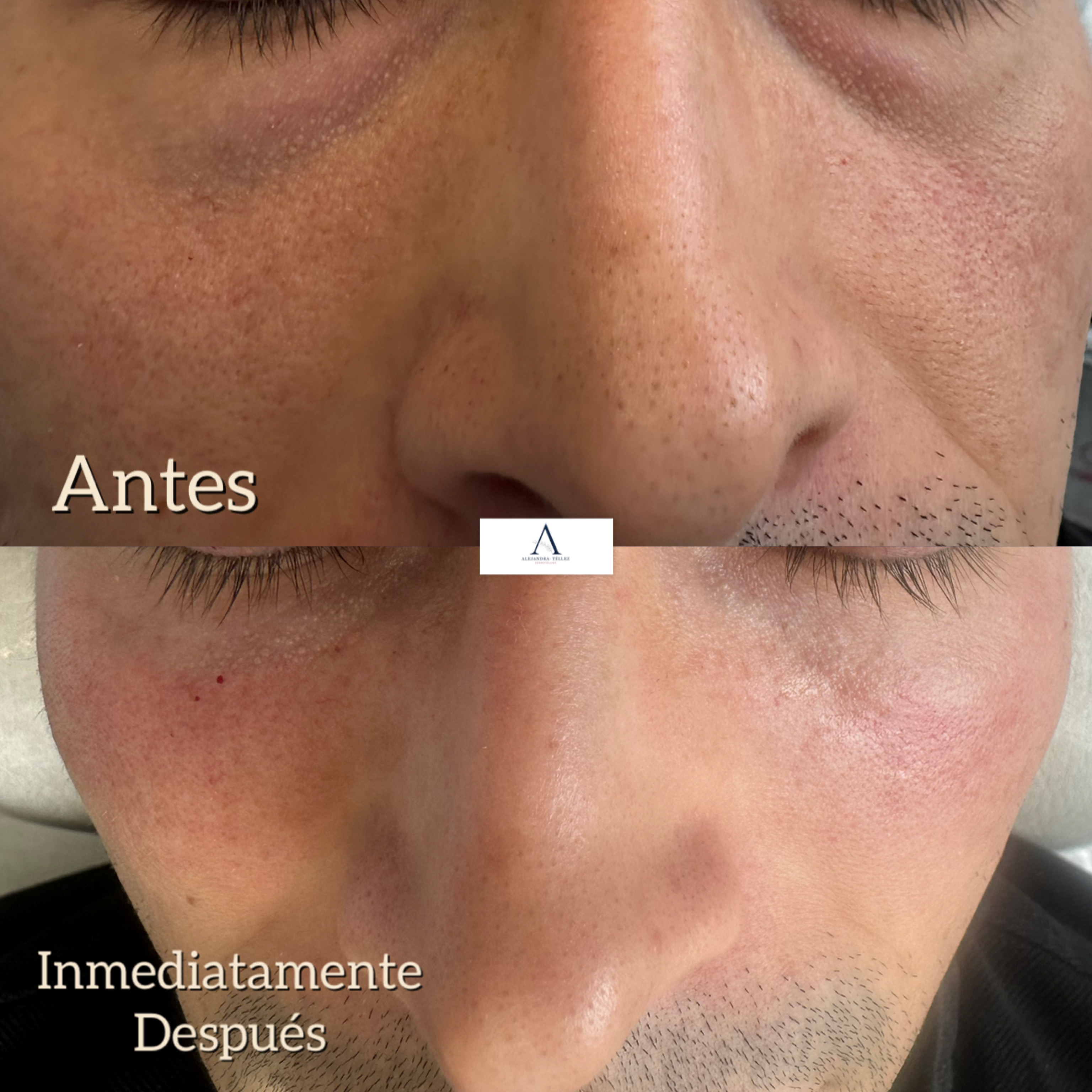 AH · Ojeras